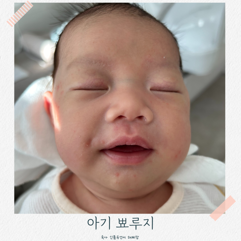 아기 뾰루지 피부 오돌토돌 아이 얼굴 좁쌀 두드러기 원인과 관리법