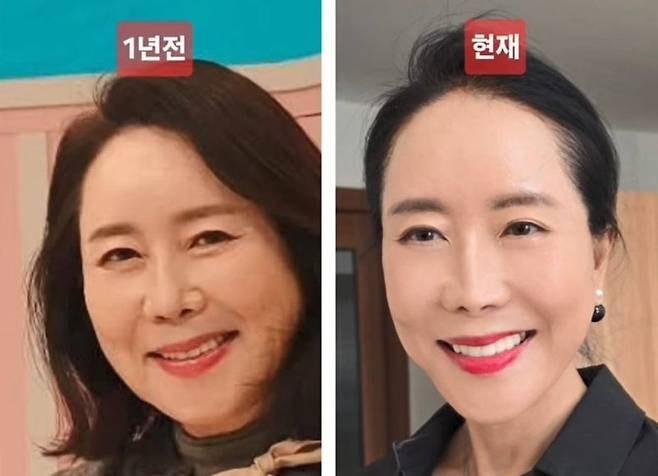아나운서 윤영미 1년간 가장 잘한 일 '안면거상술'? 안면거상술 효과와 부작용은?