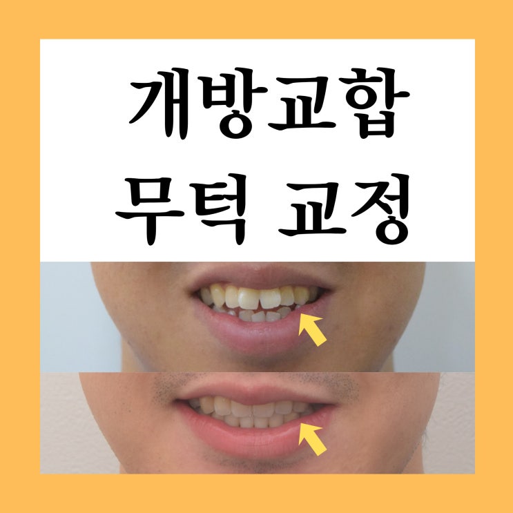  미아역치아교정, 개방교합·무턱·돌출이 동시에 있을 때 치료 설계