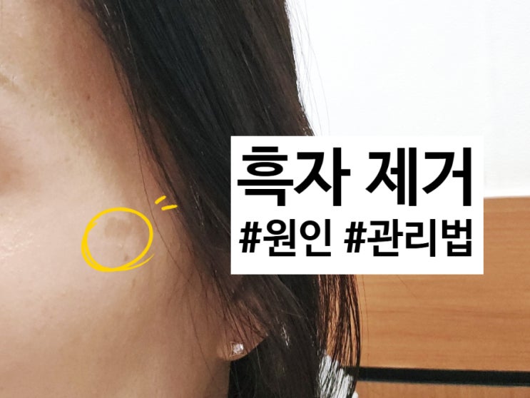  흑자 제거 비용 기미 원인 관리법