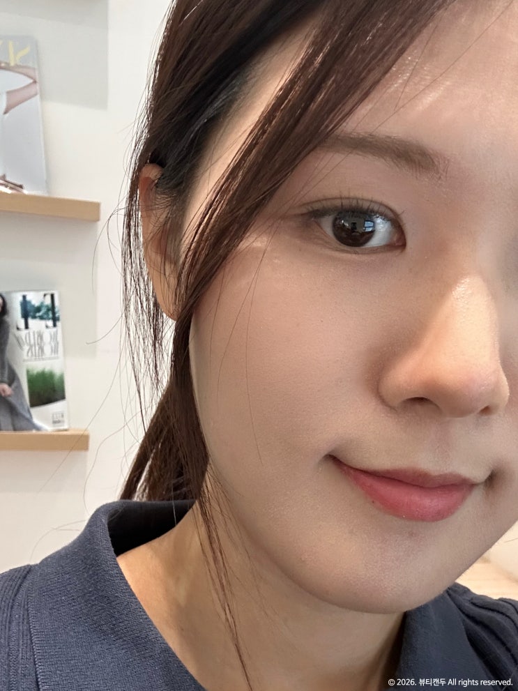 송도 피부과 스킨보톡스 효과는? 전후비교 유지기간 통증 엠보 관리 후기