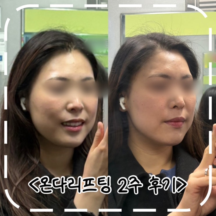  [예비신부 시술] 압구정피부과 얼굴 온다리프팅 8만줄 후기(비포/애프터)