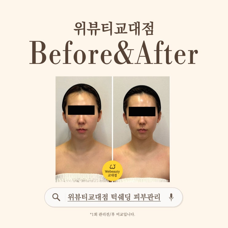  서초교대역 윤곽관리] 위뷰티 교대점 턱쉐딩 피부관리 전후/할인/이벤트