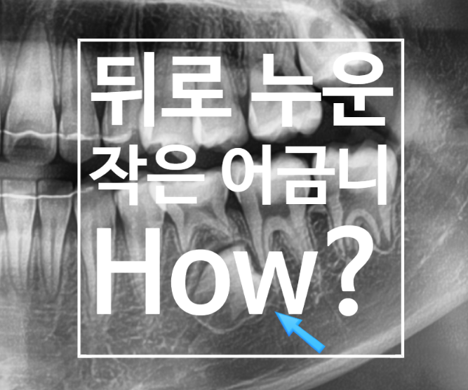  뒤로 누운 작은어금니, 꼭 뽑아야 할까요? 교정 전문의가 말하는 '기다림'의 미학, 작은어금니 맹출이상, 위치이상, 작은어금니 매복