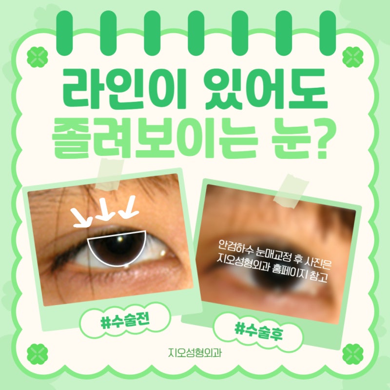 안검하수 쌍수잘하는곳, 진단이 필요한 경우