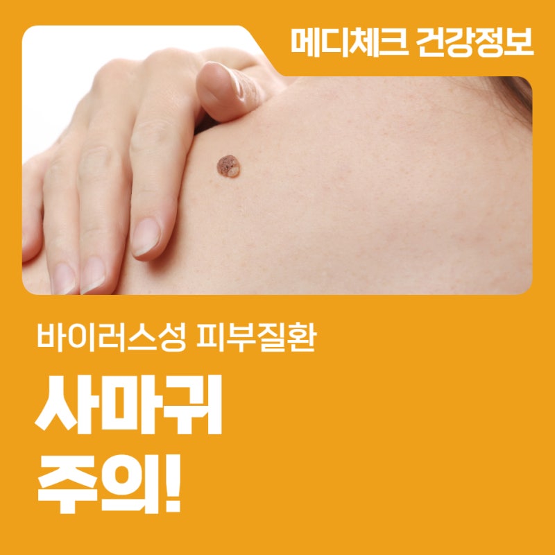 바이러스성 피부질환 사마귀 주의!