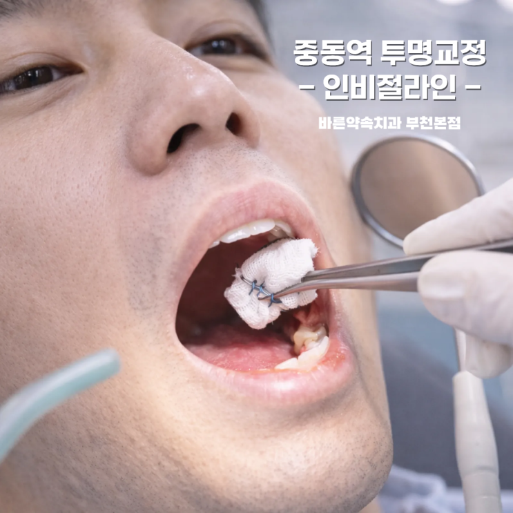  임플란트 수술 후 붓기 :: 어떻게 줄일까요?