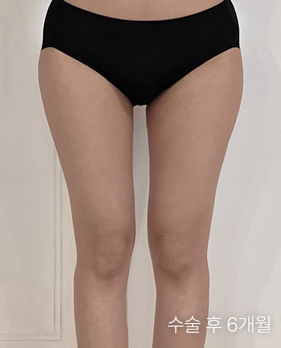  허벅지지방흡입후기 속 허벅지틈의 비밀, 실패 없는 허벅지지방흡입병원 고르는 기준은?