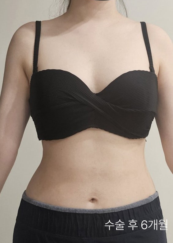  복부지방흡입가격보다 중요한 '옆구리·뒷구리' 라인 정리, 일자 허리 탈출법은?