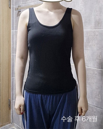  팔뚝지방흡입 흉터 위치와 팔꿈치 주름까지 잡는 디테일의 차이