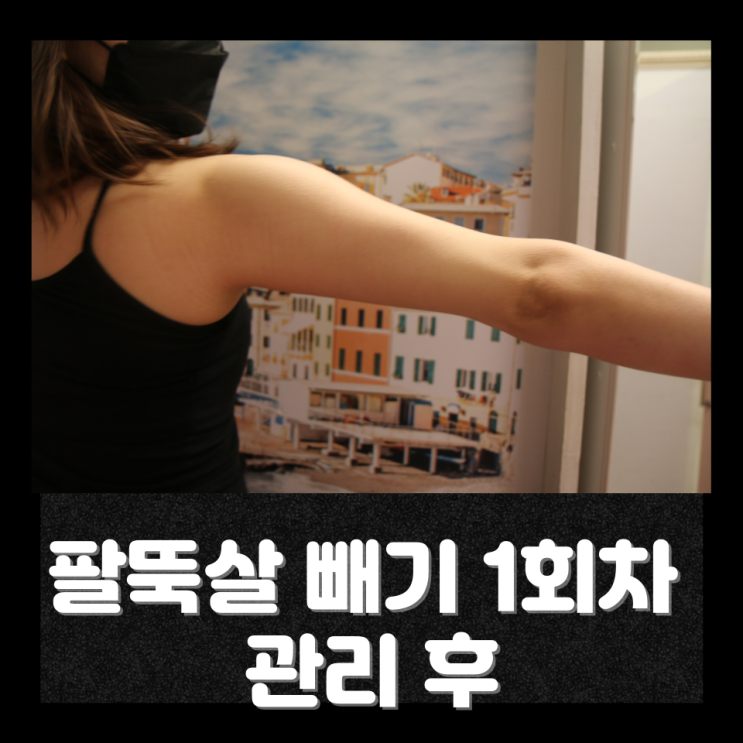  천안 피부관리 팔뚝살빼기 1회차 변화｜신부동피부관리 팔뚝 라인 이렇게 달라집니다