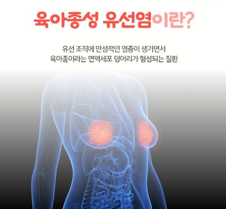 유방에 생긴 염증, 혹시 ‘육아종성 유선염’? 꼭 알아야 할 모든 것