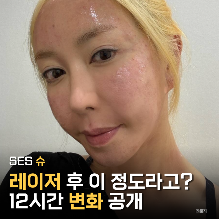  "12시간 만에 80% 진정?"슈 피부과 레이저 시술 리얼 후기+ 병풀 진정 효과