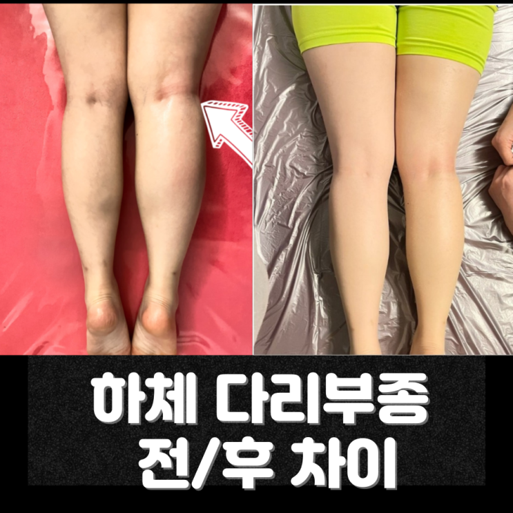  천안피부관리 하체부종부터 순환관리까지｜신부동피부관리 웰니스 관리 기준 정리