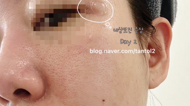 얼굴 대상포진, 단순 포진인 줄 알았다면 '이것' 확인하세요 (전조증상,고통,치료과정)
