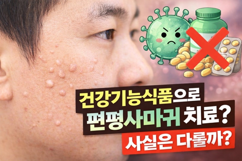 편평사마귀 약으로 치료 가능할까?
