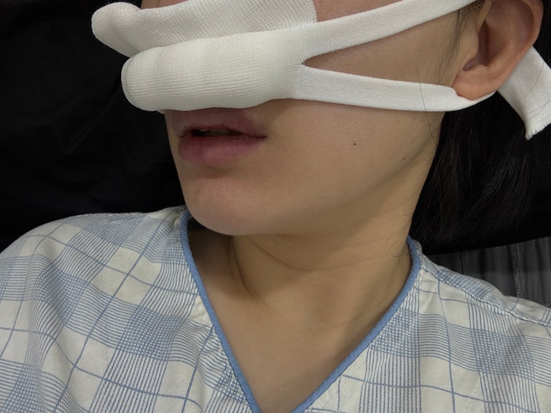 비염 수술 후기 | 수술후관리, 1-4주차후기, 실비 보험청구, 보험코드, 하비갑개절제술, 비중....
