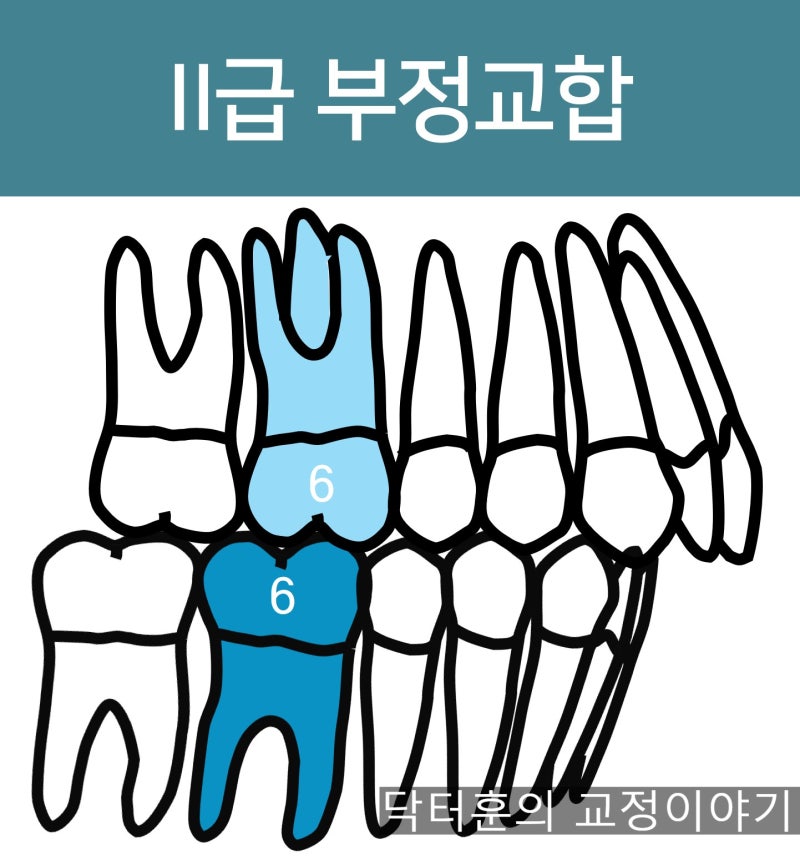 부정교합 분류: II급 부정교합이란? (Angle 2급, 앵글씨 2급 부정교합)