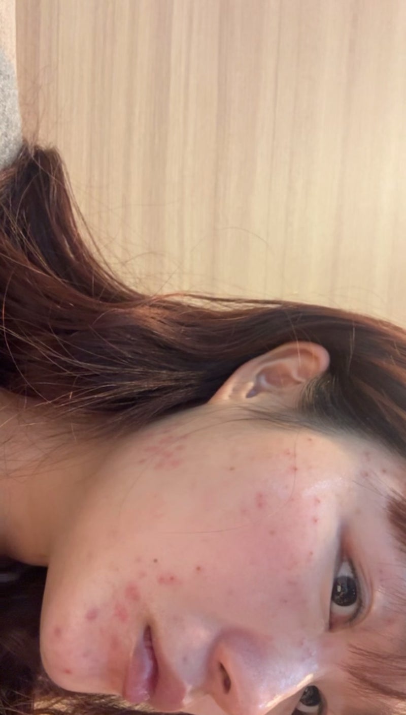 대전 편평사마귀 제거(at.한의원제거)