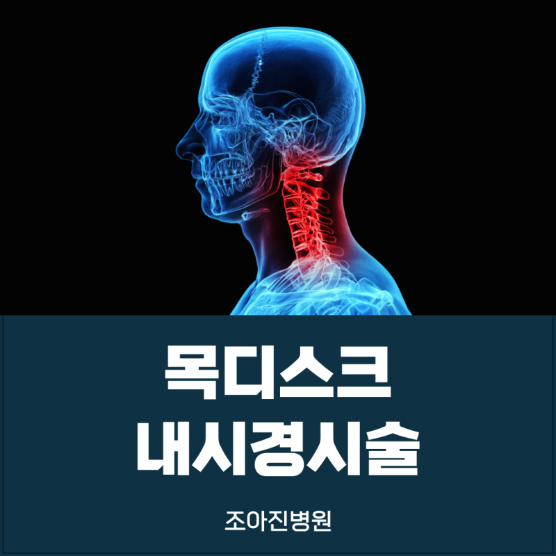 목디스크 내시경 시술 단방향 내시경 치료 원리 장점