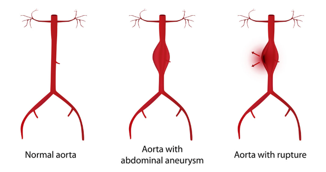 [Cardiology] 6. DDx - Aortic disease