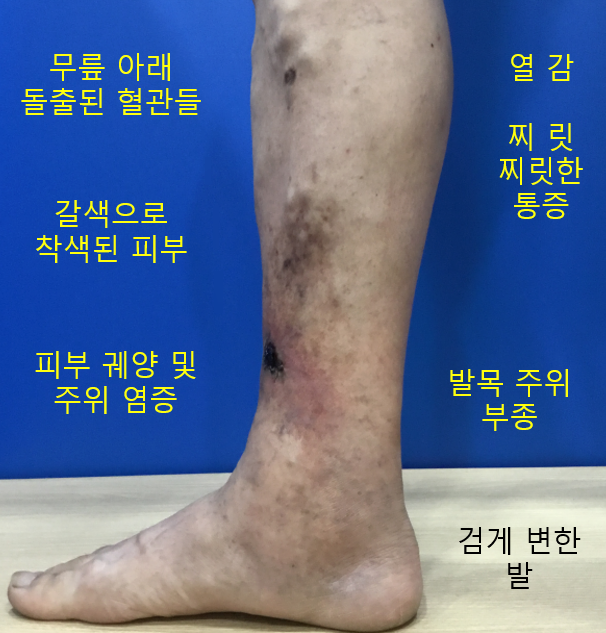 하지정맥류명의 찾으려면? 최소한 이 3가지는 확인해보세요