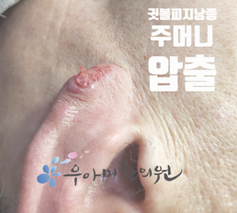 귓볼 피지낭종 병원, 어디로 가야 할지 모르겠다면?