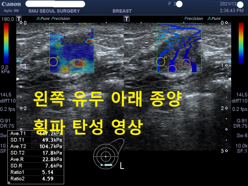유방 결절, 꼭 유방조직검사가 필요할까? '유방 횡파 탄성 초음파'의 역할