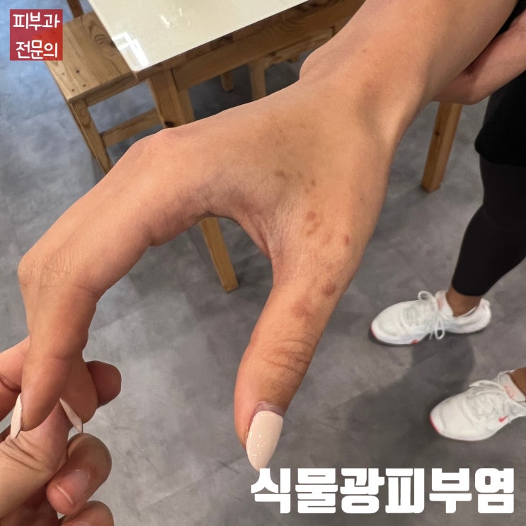  여행을 다녀와서 손에 검은 반점이 생겼어요. 식물광피부염(Phytophotodermatitis)