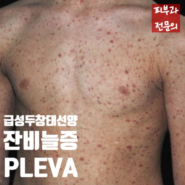  빨간 점들이 사라지지 않아요... 급성두창태선모양잔비늘증(PLEVA)