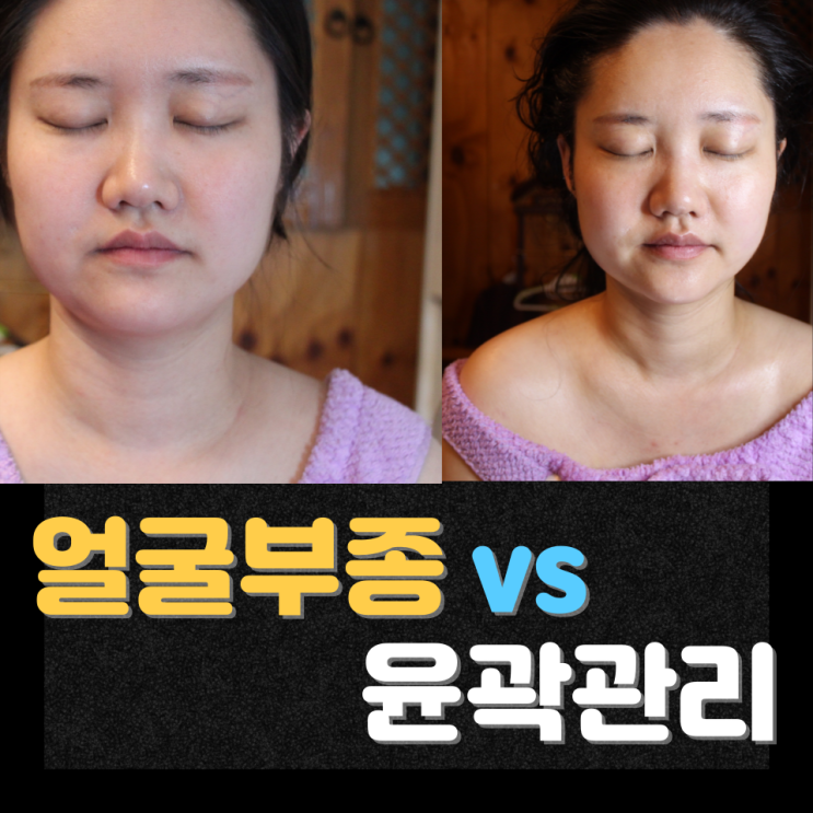  천안 피부관리 얼굴부종과 윤곽관리 헷갈릴 때 차이를 판단하는 기준｜신부동피부관리