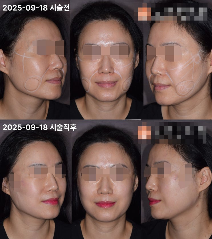  포항 리프팅 병원, 고주파·초음파 반복해도 얼굴이 다시 처지는 이유 〈한방 매선〉