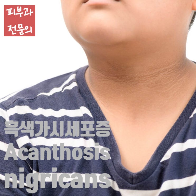  목과 겨드랑이가 까맣게 보여요, 흑색가시세포증 (Acanthosis nigricans)