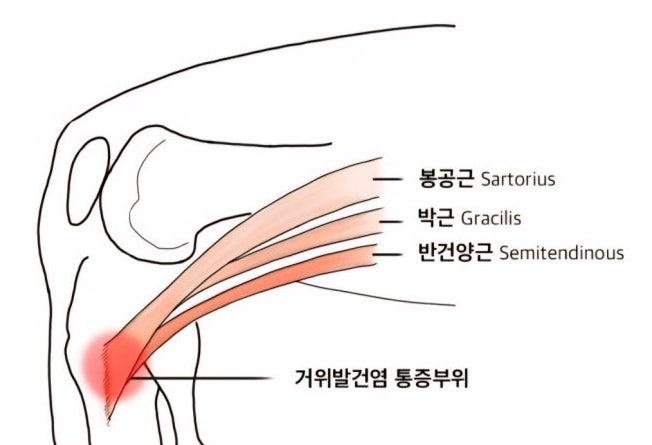 거위발건염 (무릎 안쪽만 콕 집어 아프다면)