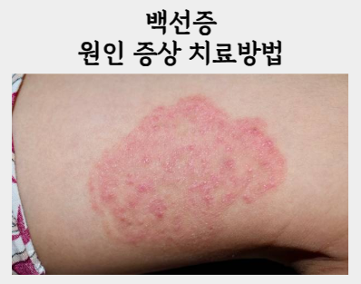 "백선증 피부가 가렵다면 꼭 확인해 보세요"