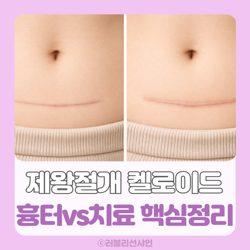제왕절개 켈로이드 원인 흉터 부터 주사 비용 연고까지 한 번에 정리