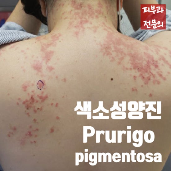 다이어트 후 생긴 붉은 발진, 색소성양진(Prurigo pigmentosa)