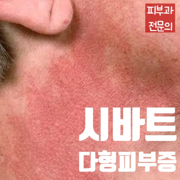  얼굴과 목이 붉으면 모두 알러지일까? 시바트 다형피부증 (Poikiloderma of Civatte)