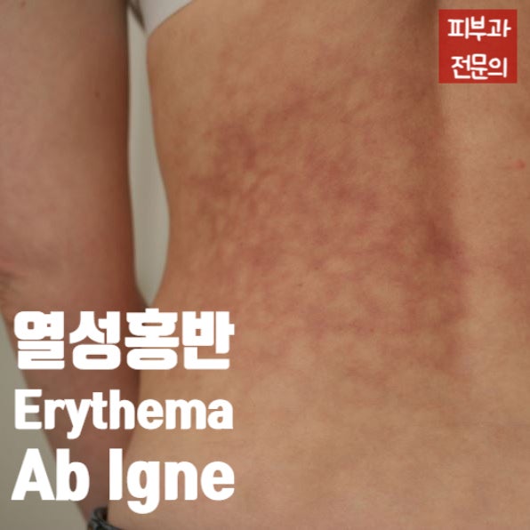  열성홍반 Erythema ab igne, 난로/온찜질/핫팩/노트북으로 인한 그물모양의 홍반과 색소침착