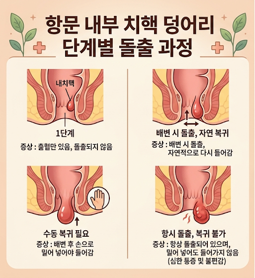 항문에 덩어리가? 치질 증상 1기~4기 자가진단 및 치핵 자연치유 방법
