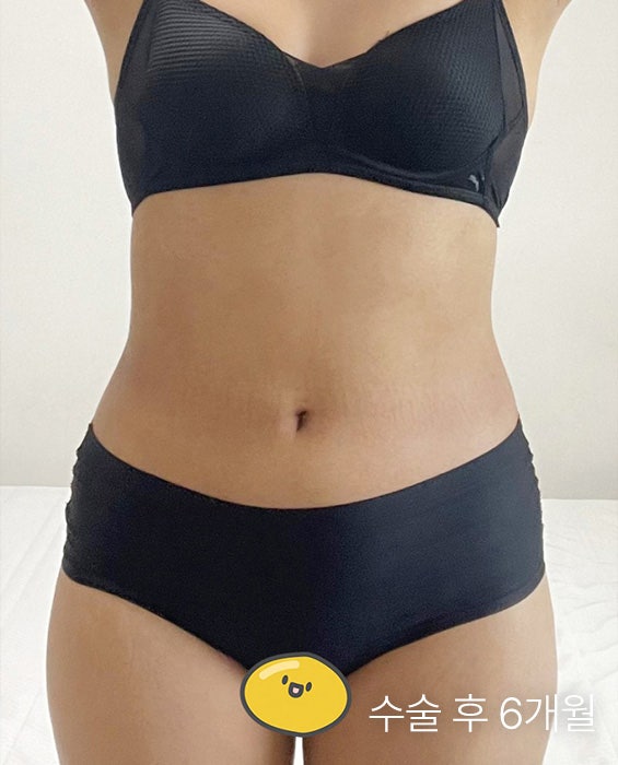  허리지방흡입 부작용 피하려면? 울퉁불퉁함 없이 매끈한 복부 허리라인 만드는 방법