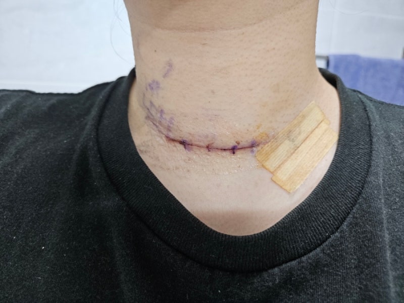 분당서울대 이비인후과 차원재 교수님 갑상선 유두암 수술 후기