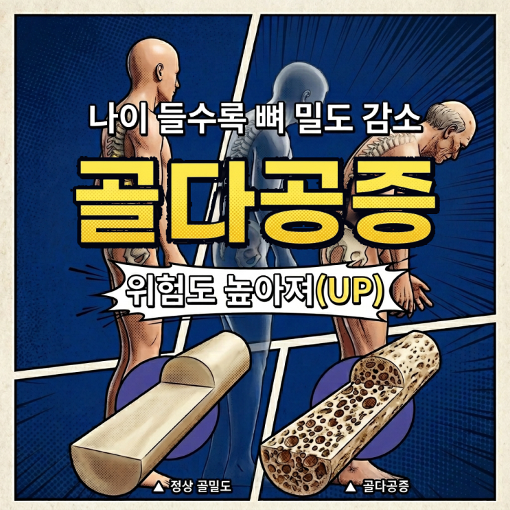  구파발정형외과, 구멍 숭숭 골다공증 건강 지키는 4가지 습관