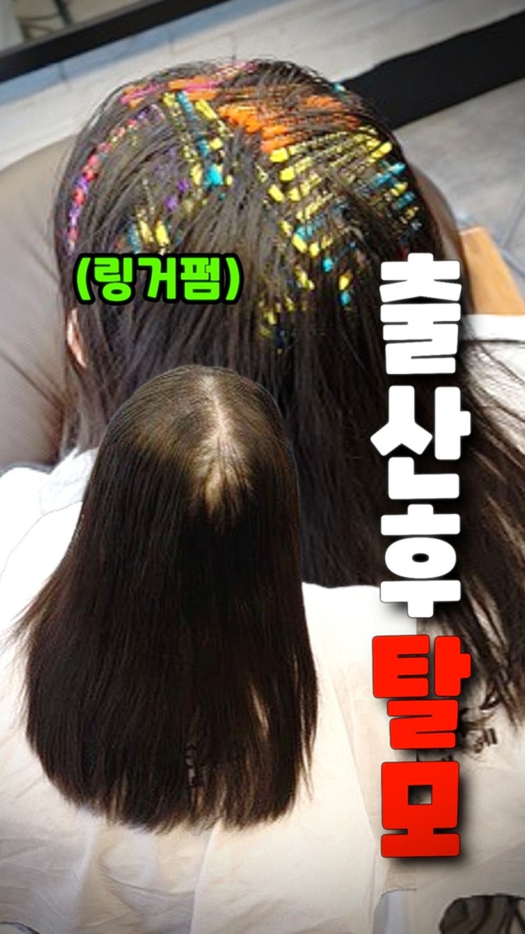  천안 신부동 출산후 탈모 고민, 수원 율전동 링거펌으로 해결!