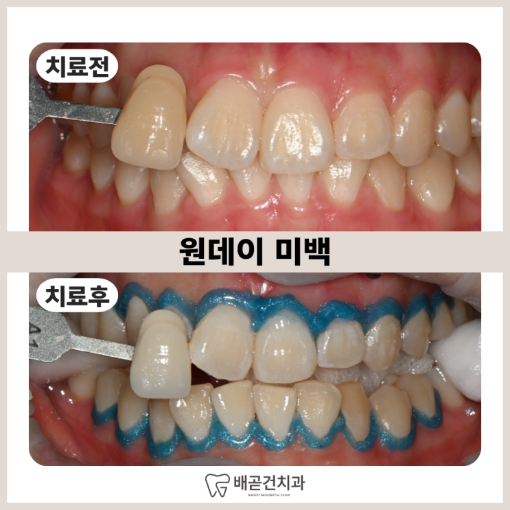  원데이 미백, 30분 만에 효과 날까요? 배곧 치과에서 직접 해봤습니다