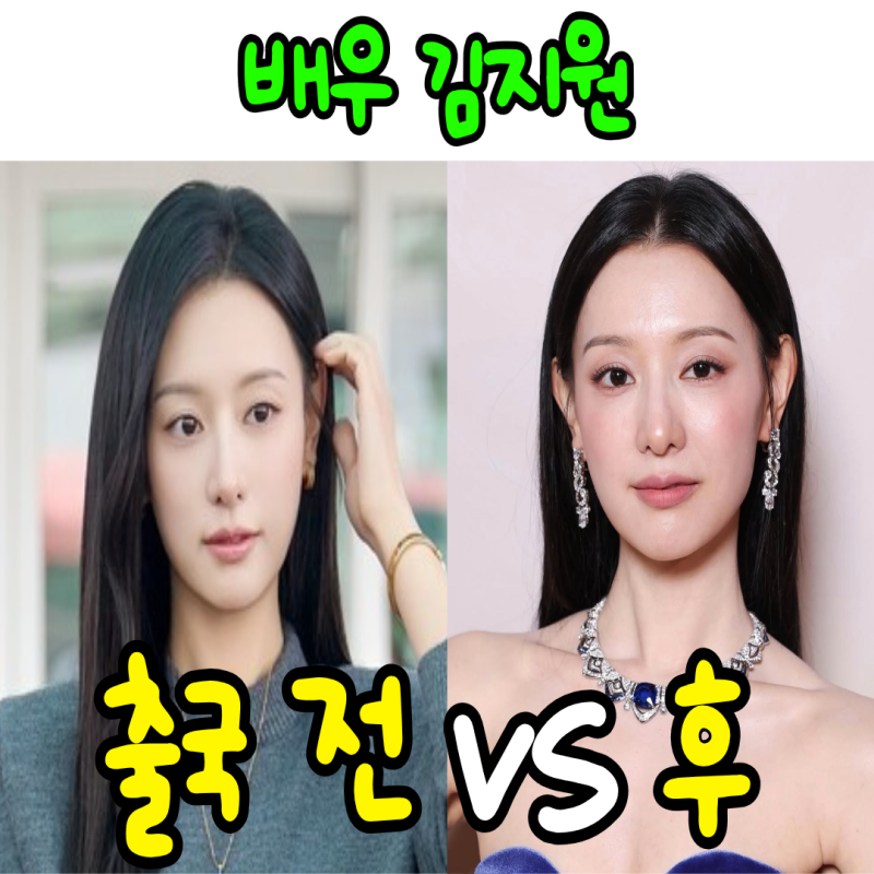 최근 뼈말라 된 배우 김지원, 엇갈리는 반응들? "시술이다 VS 헤메코 때문이다"