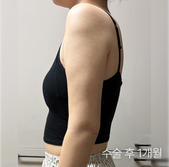  팔지방흡입압박복 꼭 입어야 할까? SVF 재생 지방흡입의 탄력 개선과 밀착력의 시너지
