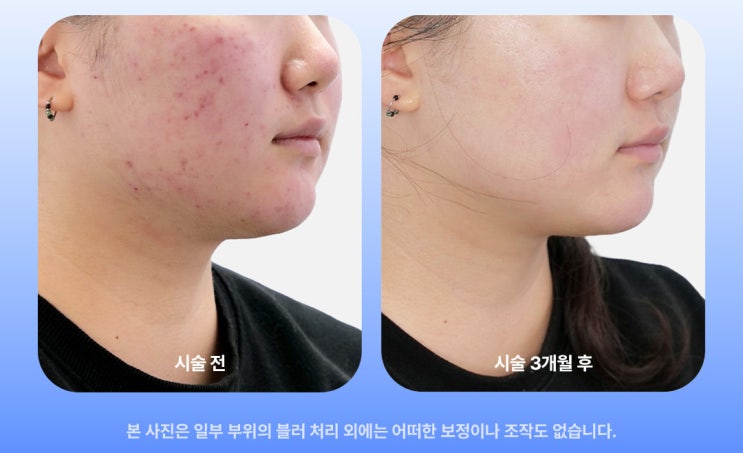  울트라펄스 알파 후기, 흉터 치료 전 꼭 확인해야 할 3가지 판단 기준