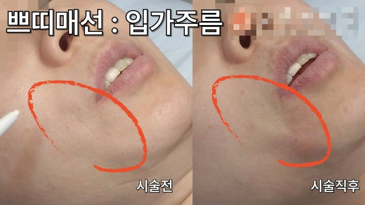  포항 실리프팅 추천, 피부가 얇아서 리프팅 못 받는다고요? 그건 오해입니다