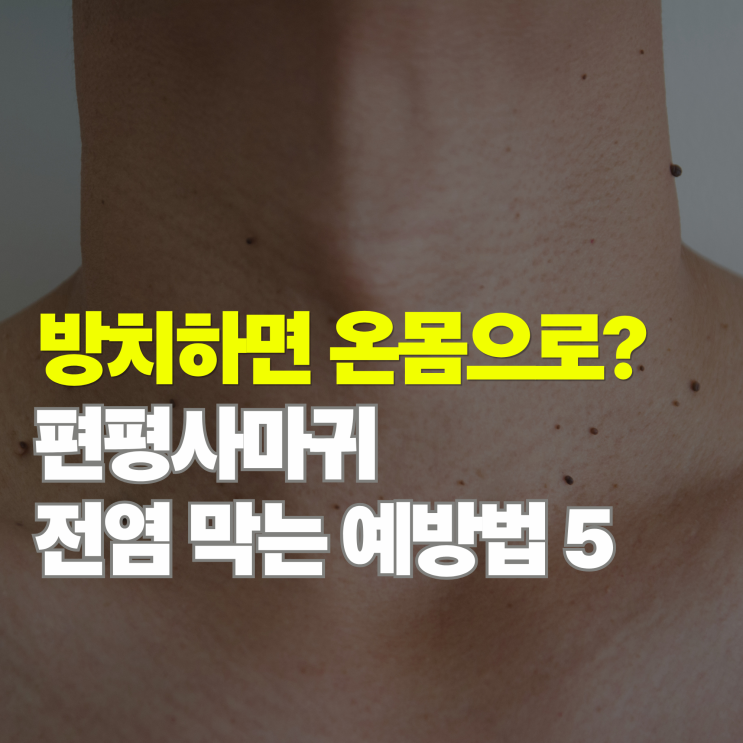  방치하면 온몸으로? 편평사마귀 번지는 이유와 전염 예방법